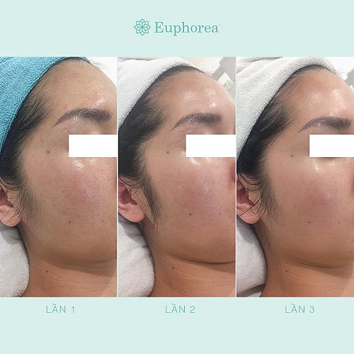 Tất cả những điều bạn cần biết về Peel da (Pro Power Peel) tại Euphorea