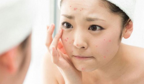 Kỳ vọng phát triển các phương pháp điều trị mụn trứng cá trong tương lai thông qua gen di truyền